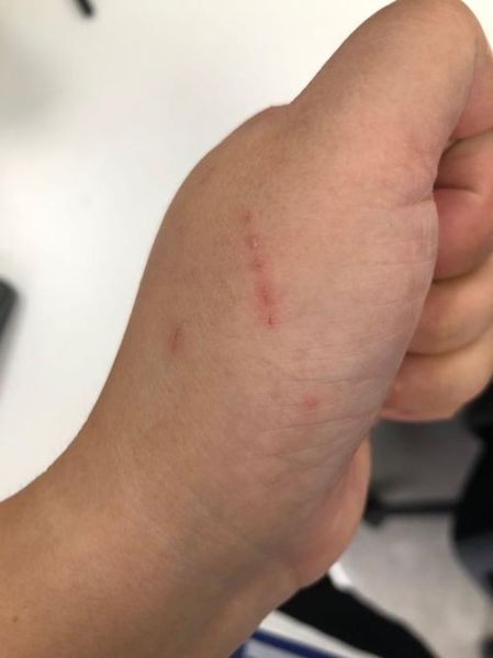 猫挠出血不打针有事吗(会不会感染狂犬病)