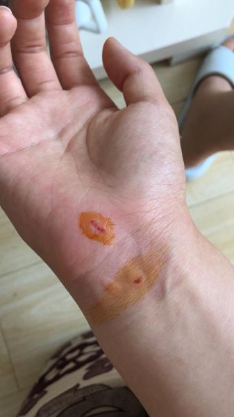 猫挠出血不打针有事吗(会不会感染狂犬病)
