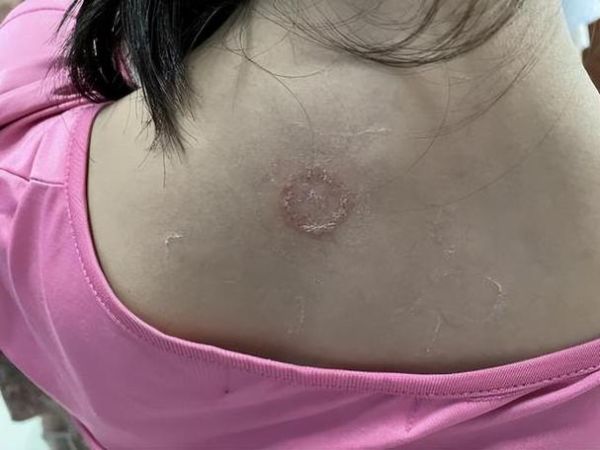 猫藓(是接触了猫癣的东西才会得吗)