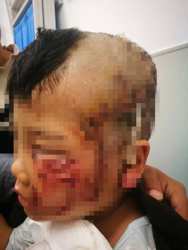 男孩遭宠物犬撕咬(谁来保护孩子)