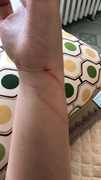 被猫抓伤出血要打针吗(打针能完全预防狂犬病吗)