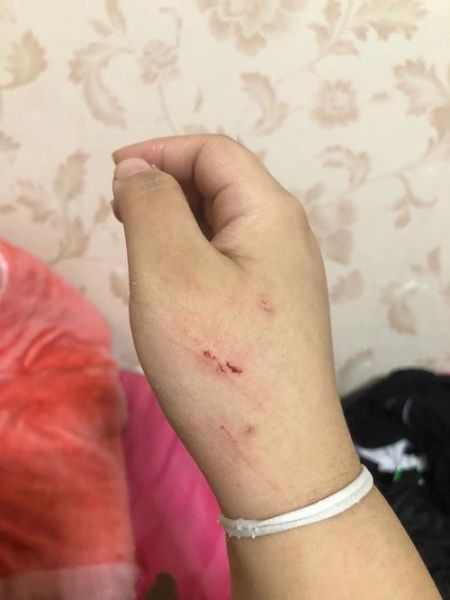 被猫抓伤出血要打针吗(打针能完全预防狂犬病吗)