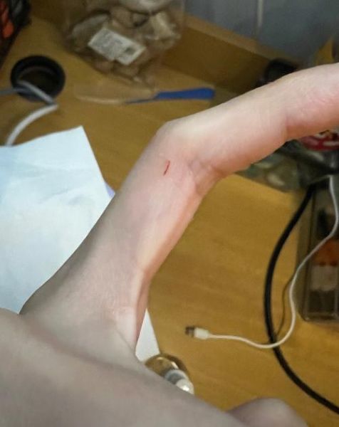 被猫抓破了怎么办(用碘酒还是酒精)