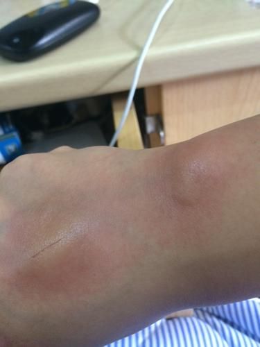 被猫抓破了怎么办(用碘酒还是酒精)