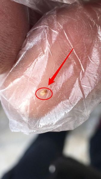 金毛虫(到底有什么区别)